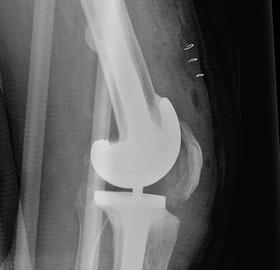 Distal Femoral Augment